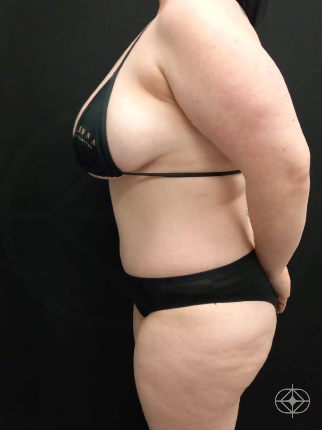 Resultado após Abdominoplastia realizado por Dra. Taís Saraceno