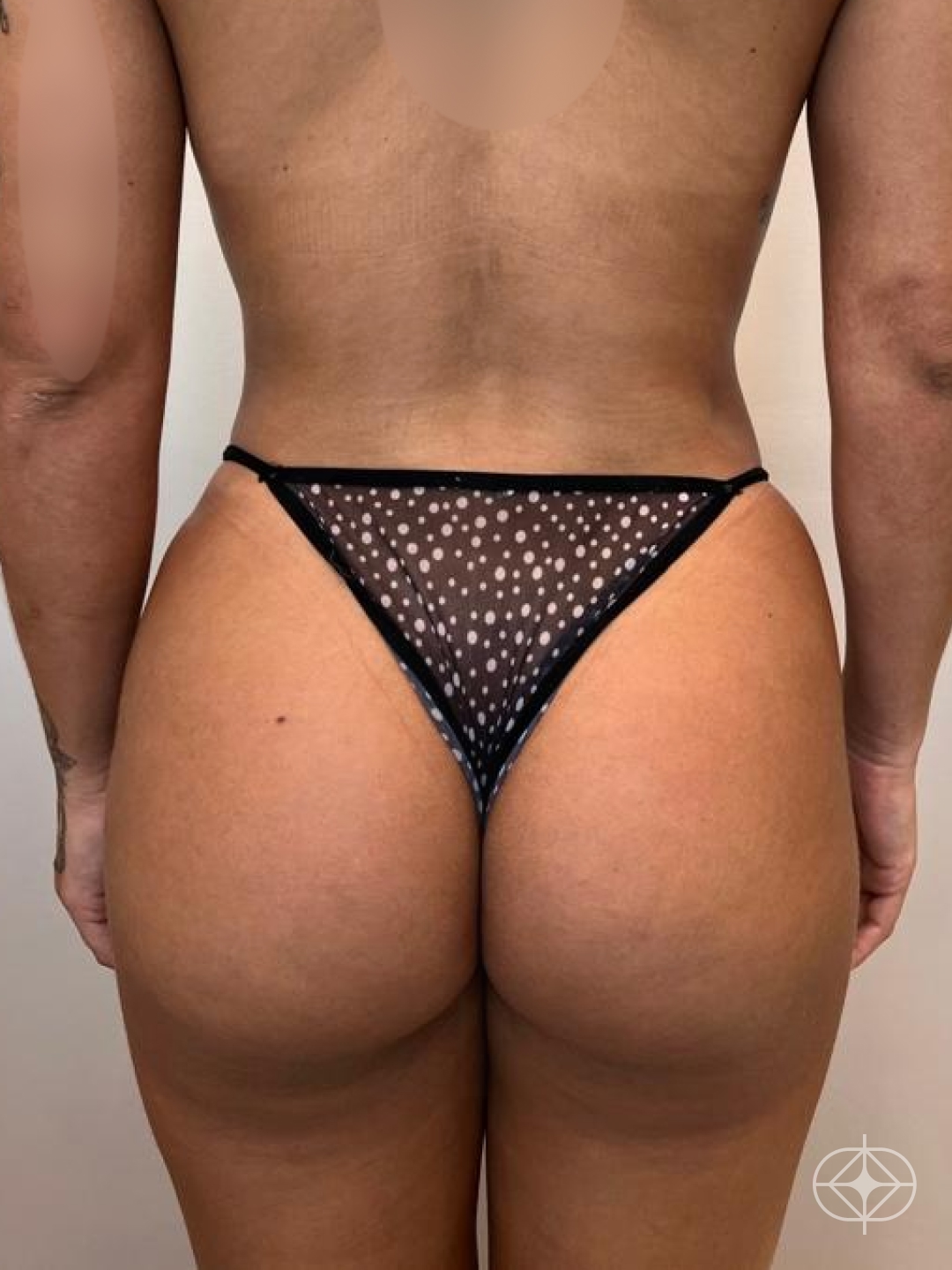 Resultado após Lipoaspiração / Lipo HD realizado por Dr. Igor Rocha