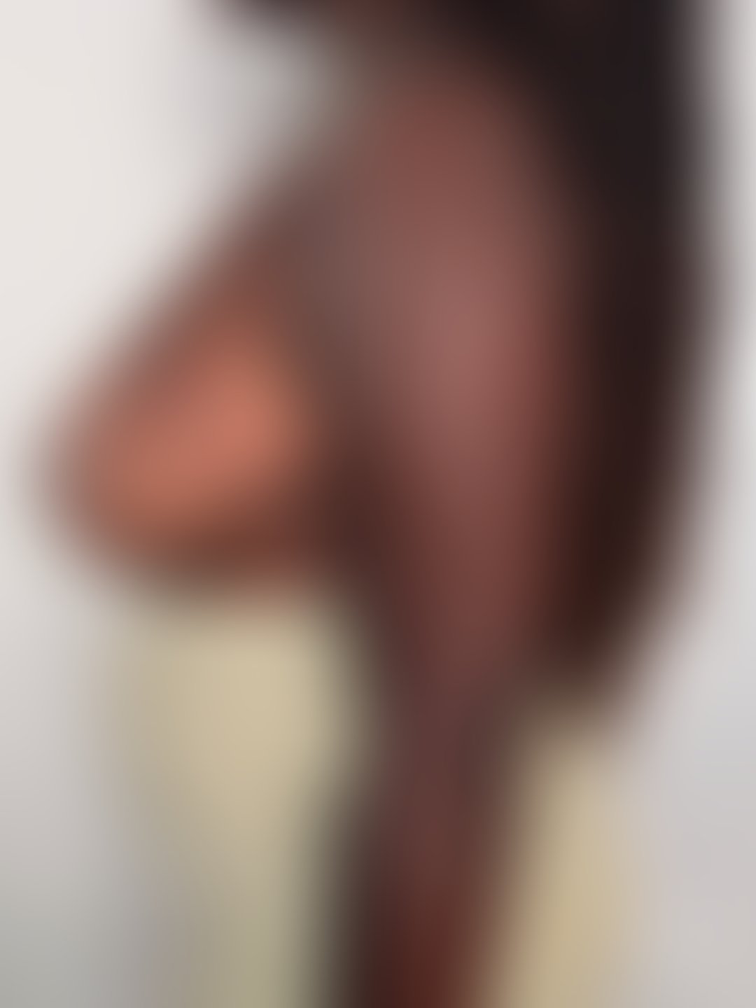Foto antes de Mamoplastia Redutora realizado por Dr. Igor Rocha