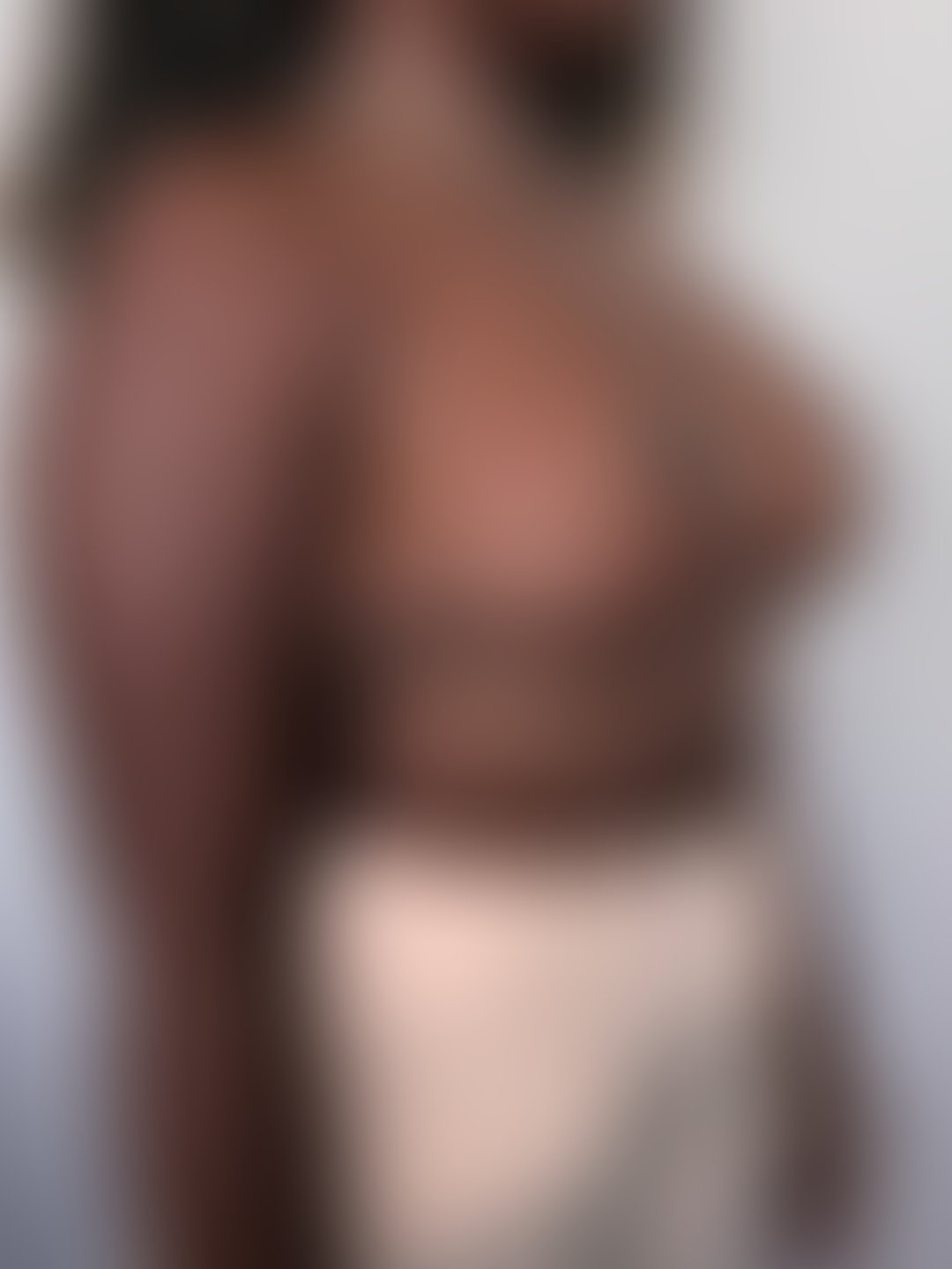 Resultado após Mamoplastia Redutora realizado por Dr. Igor Rocha